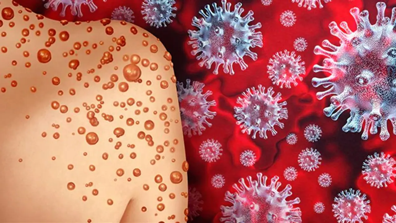 দেশে বাড়ছে মাঙ্কিপক্সে আক্রান্তের সংখ্যা, পরিস্থিতি মোকাবিলায় টাস্ক ফোর্স গঠন মোদী সরকারের দেশে বাড়ছে মাঙ্কিপক্সে আক্রান্তের সংখ্যা, পরিস্থিতি মোকাবিলায় টাস্ক ফোর্স গঠন মোদী সরকারের