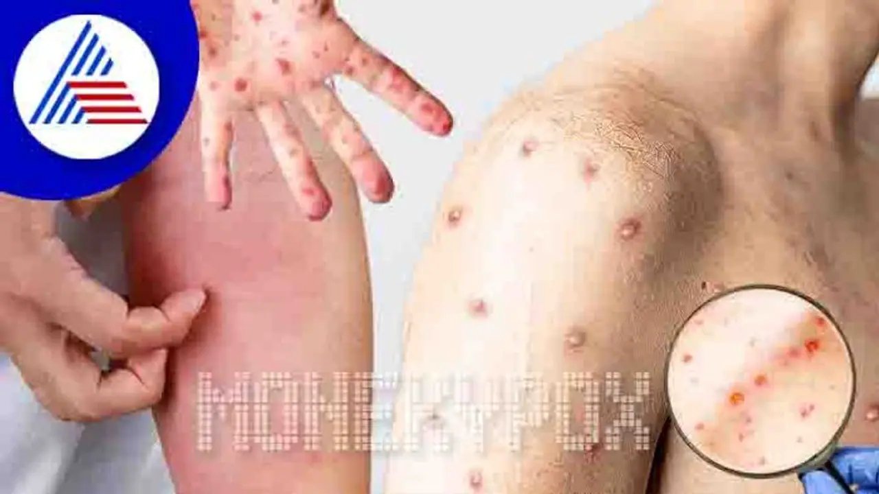 ಮಂಕಿಪಾಕ್ಸ್ ಹರಡುವಿಕೆ ಆರಂಭದಲ್ಲೇ ತಡೆಯುವುದು ನಿರ್ಣಾಯಕ: ತಜ್ಞರು