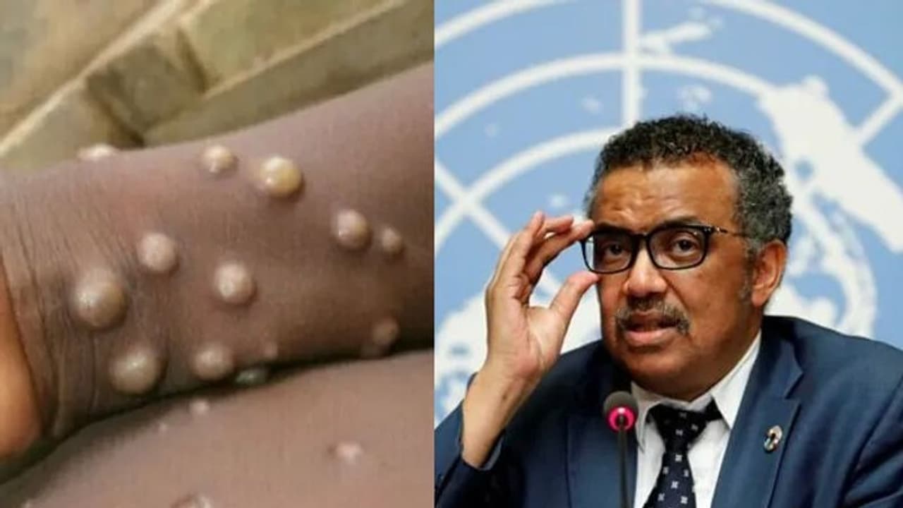 'যৌন সঙ্গীর সংখ্যা দ্রুত কমান', মাঙ্কি পক্স ইস্যুতে পুরুষদের সতর্ক করল বিশ্ব স্বাস্থ্য সংস্থা 'যৌন সঙ্গীর সংখ্যা দ্রুত কমান', মাঙ্কি পক্স ইস্যুতে পুরুষদের সতর্ক করল বিশ্ব স্বাস্থ্য সংস্থা