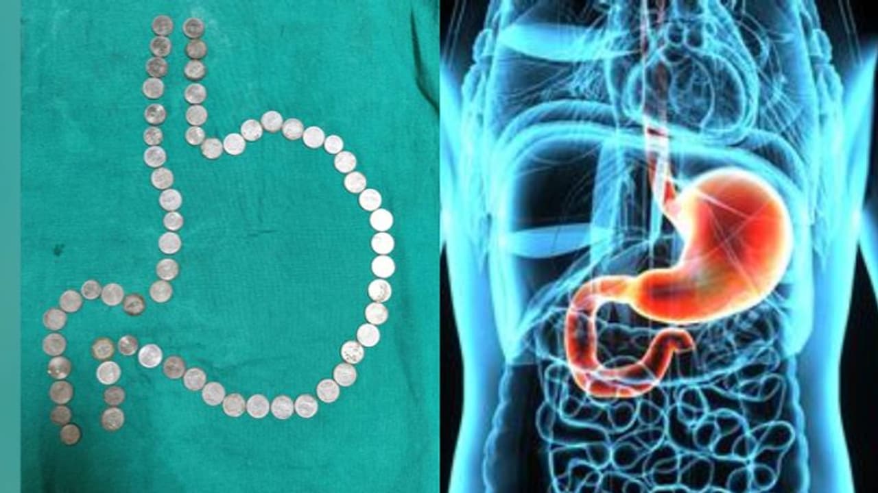 പരിശോധിച്ചപ്പോൾ ഡോക്ടർമാർ ഞെട്ടി; യുവാവിന്റെ വയറ്റിൽ 50 നാണയങ്ങൾ!, പുറത്തെടുത്തത് ശസ്ത്രക്രിയയില്ലാതെ പരിശോധിച്ചപ്പോൾ ഡോക്ടർമാർ ഞെട്ടി; യുവാവിന്റെ വയറ്റിൽ 50 നാണയങ്ങൾ!, പുറത്തെടുത്തത് ശസ്ത്രക്രിയയില്ലാതെ