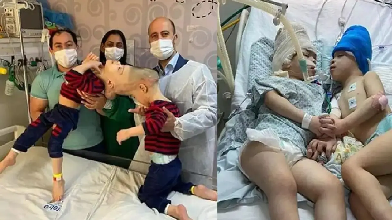 3 ವರ್ಷದ ಸಯಾಮಿ ಬಾಲಕರ ಯಶಸ್ವಿಯಾಗಿ ಬೇರ್ಪಡಿಸಿದ ವೈದ್ಯರು: 27 ಗಂಟೆಗಳ ಸುದೀರ್ಘ ಶಸ್ತ್ರಚಿಕಿತ್ಸೆ