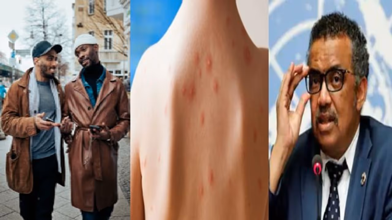 সমকামী মানেই মাঙ্কিপক্সের বাহক নন, বার্তা স্পষ্ট করল বিশ্ব স্বাস্থ্য সংস্থা সমকামী মানেই মাঙ্কিপক্সের বাহক নন, বার্তা স্পষ্ট করল বিশ্ব স্বাস্থ্য সংস্থা