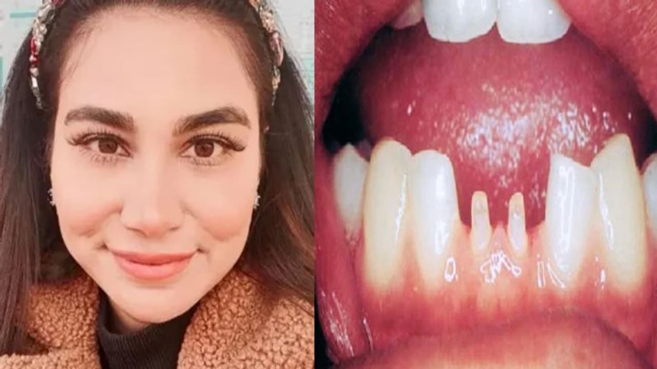 खूबसूरत स्माइल पाने की चाहत में महिला की छीन गई मुस्कान, डेंटिस्ट ने किया कुछ ऐसा हाल खूबसूरत स्माइल पाने की चाहत में महिला की छीन गई मुस्कान, डेंटिस्ट ने किया कुछ ऐसा हाल