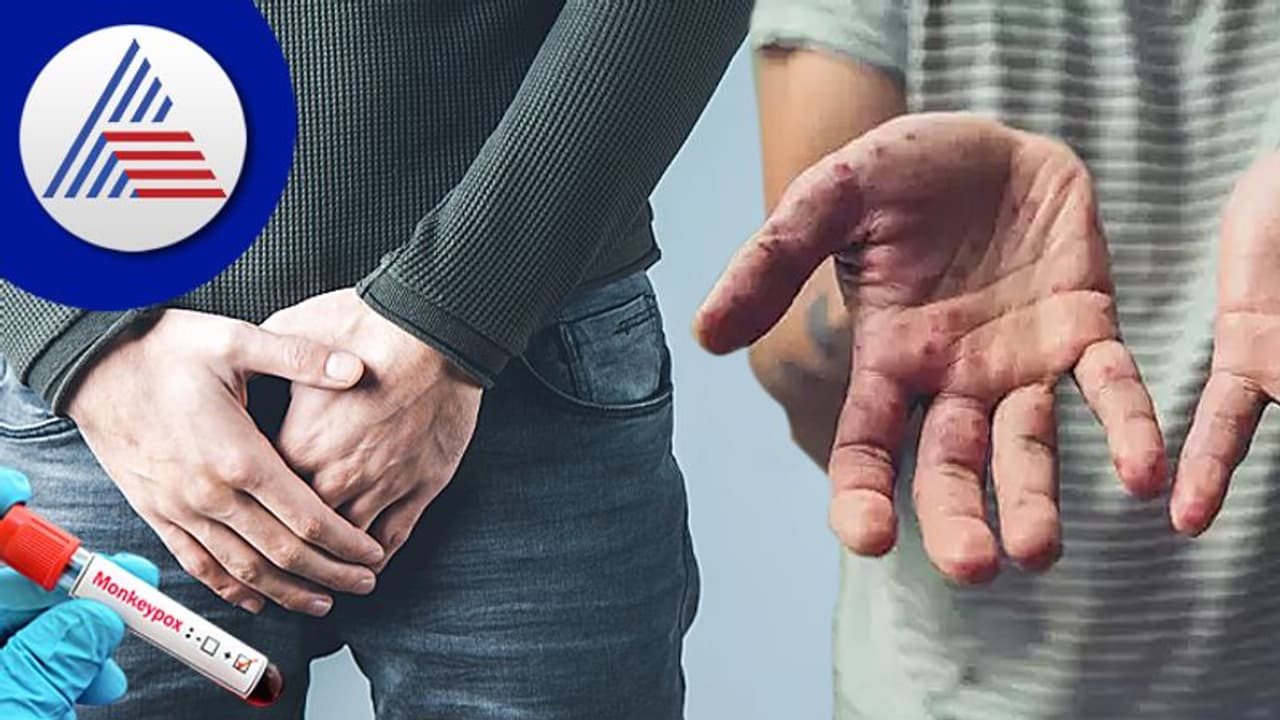 Monkeypox Symptoms: ಜನನಾಂಗದಲ್ಲೂ ಕಾಣಿಸಿಕೊಳ್ಳುತ್ತೆ ಕೆಂಪು ಗುಳ್ಳೆ !