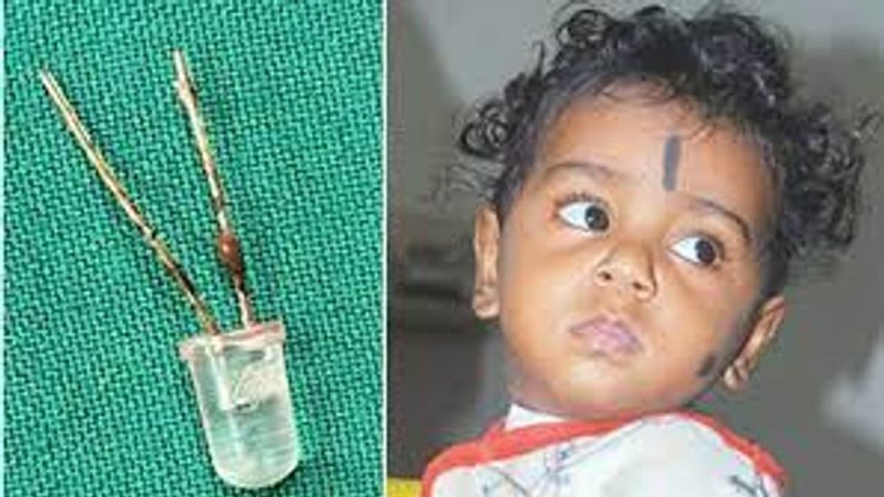 எல்.இ.டி பல்பை விழுங்கிய 10 மாத குழந்தை.. மூச்சு குழாயில் சிக்கிய பல்பு.. ஒரு மணி நேரம் நடந்த அறுவை சிகிச்சை.. எல்.இ.டி பல்பை விழுங்கிய 10 மாத குழந்தை.. மூச்சு குழாயில் சிக்கிய பல்பு.. ஒரு மணி நேரம் நடந்த அறுவை சிகிச்சை..