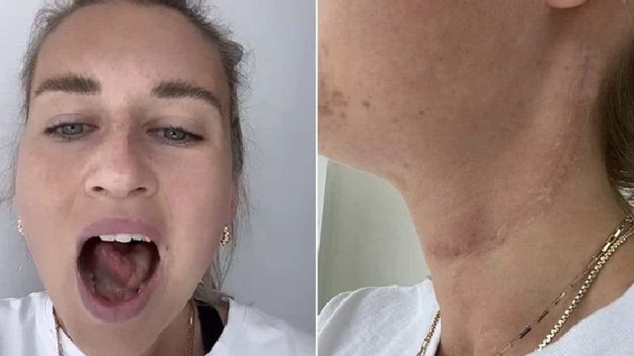 Tongue Cancer : വായില്‍ എപ്പോഴും പുണ്ണ്, വിസ്ഡം പല്ലിന്‍റെ പ്രശ്നമെന്ന് ഡോക്ടര്‍മാര്‍; ഒടുവില്‍ നാവ് നഷ്ടമായി 