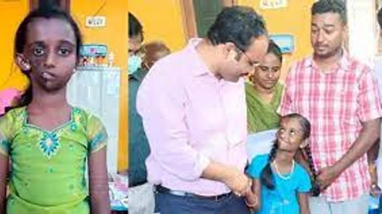 அரிய வகை முகச்சிதைவு நோயால் பாதிக்கப்பட்ட சிறுமிக்கு அறுவை சிக்கிச்சை.. முதலமைச்சர் உத்தரவு..