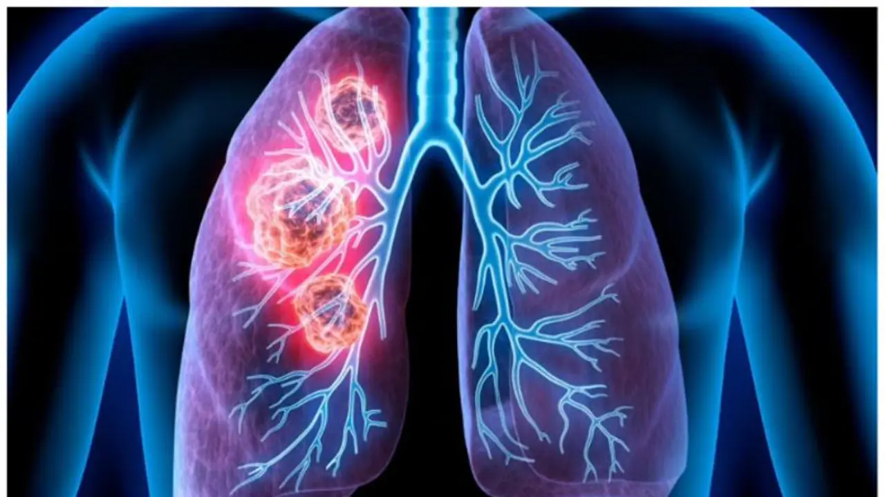 ശ്വാസകോശ ക്യാന്‍സര്‍ സാധ്യത തടയാൻ ഇക്കാര്യങ്ങൾ ശ്രദ്ധിക്കാം