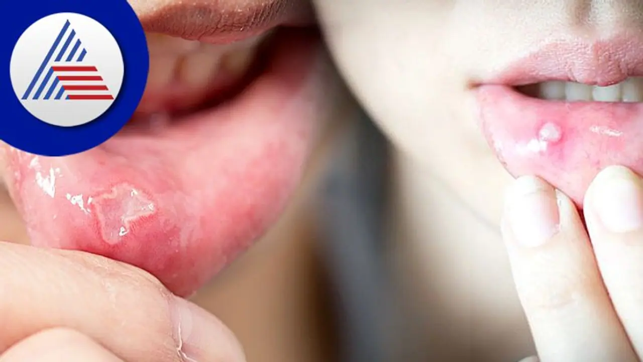 Health Tips : ಬಾಯಿಯ ಈ ರೋಗ ದೊಡ್ಡ ಖಾಯಿಲೆಯ ಲಕ್ಷಣ