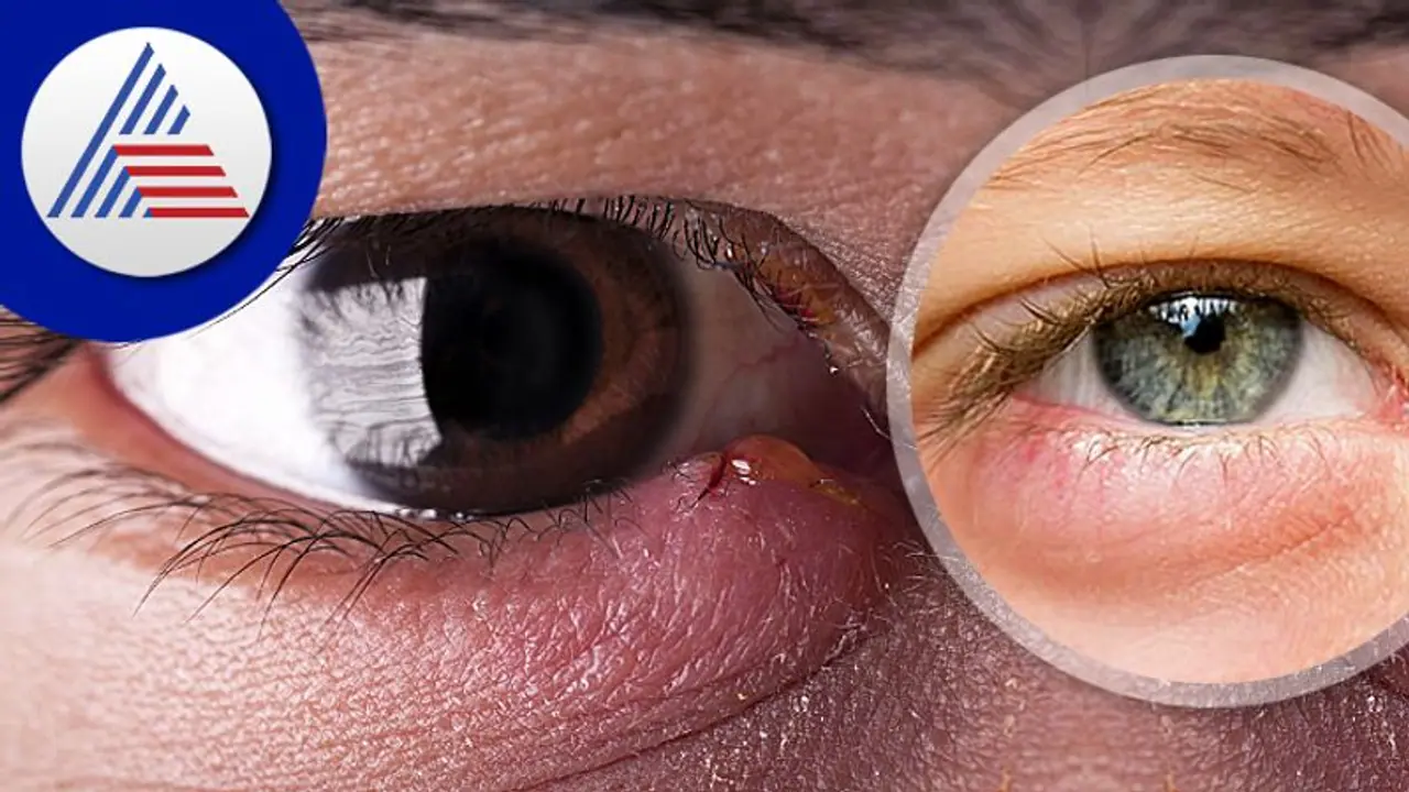 Eye Health : ಕಣ್ಣಿನ ಕೆಳ ಭಾಗ ಊದಿಕೊಳ್ಳೋದೇಕೆ? Eye Health : ಕಣ್ಣಿನ ಕೆಳ ಭಾಗ ಊದಿಕೊಳ್ಳೋದೇಕೆ?