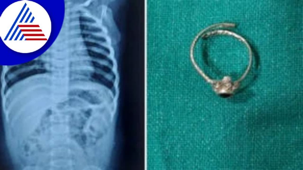 ಎದೆಹಾಲು ಕುಡಿಯದೆ ಅಳ್ತಿತ್ತು ಮಗು, ಎಕ್ಸ್ರೇ ತೆಗೆದ್ರೆ ಶ್ವಾಸಕೋಶದಲ್ಲಿತ್ತು ಕಾಲುಂಗುರ ! ಎದೆಹಾಲು ಕುಡಿಯದೆ ಅಳ್ತಿತ್ತು ಮಗು, ಎಕ್ಸ್ರೇ ತೆಗೆದ್ರೆ ಶ್ವಾಸಕೋಶದಲ್ಲಿತ್ತು ಕಾಲುಂಗುರ !