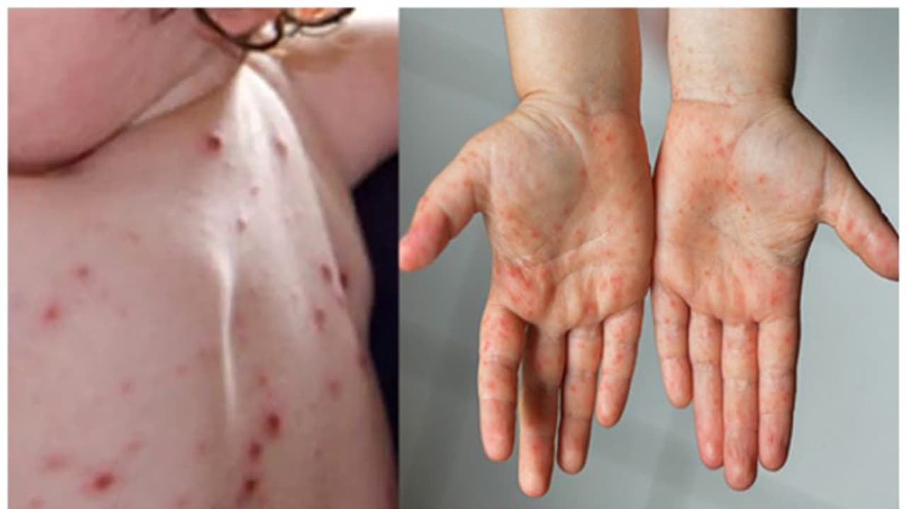 Tomato flu : തക്കാളിപ്പനി ; രക്ഷിതാക്കൾ പ്രധാനമായി ശ്രദ്ധിക്കേണ്ട കാര്യങ്ങൾ