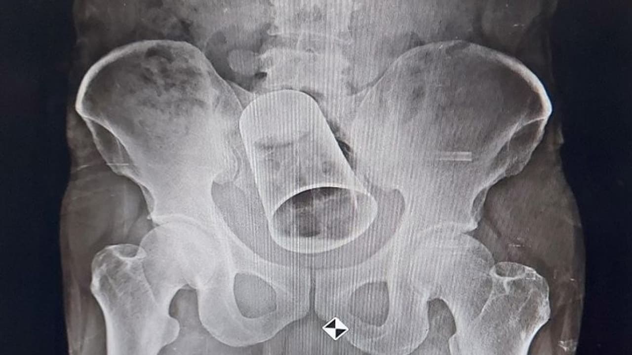 दोस्तों ने प्राइवेट पार्ट में डाल दिया स्टील का ग्लास, 10 दिन बाद डॉक्टरों ने सर्जरी कर बचाई जान