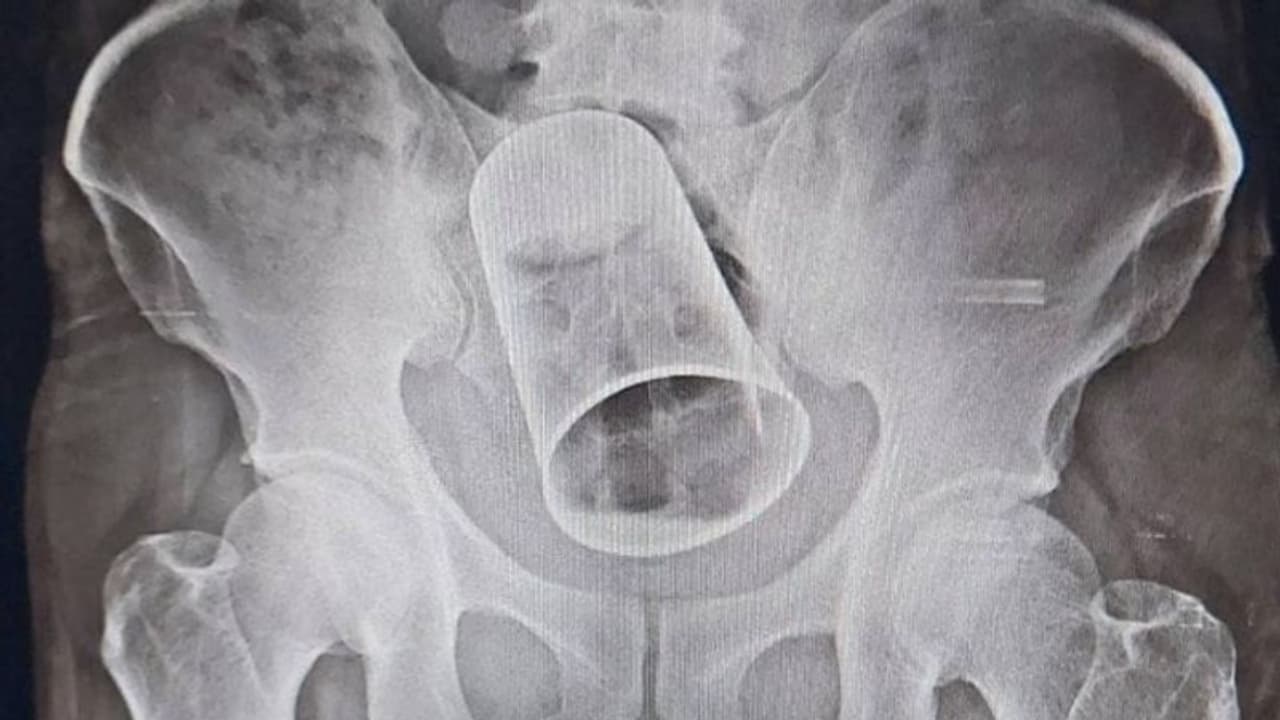 മദ്യലഹരിയില് യുവാവിന്റെ സ്വകാര്യഭാഗത്ത് സ്റ്റീല് ഗ്ലാസ് കുത്തിക്കയറ്റി, പുറത്തെടുത്തത് 10 ദിവസം കഴിഞ്ഞ് മദ്യലഹരിയില് യുവാവിന്റെ സ്വകാര്യഭാഗത്ത് സ്റ്റീല് ഗ്ലാസ് കുത്തിക്കയറ്റി, പുറത്തെടുത്തത് 10 ദിവസം കഴിഞ്ഞ്