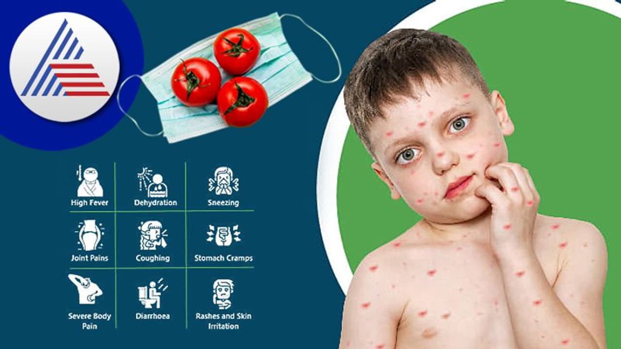 Tomato Fever: ಟೊಮ್ಯಾಟೋ ಜ್ವರ ಯಾಕಾಗಿ ಬರುತ್ತೆ? ಲಕ್ಷಣವೇನು? Tomato Fever: ಟೊಮ್ಯಾಟೋ ಜ್ವರ ಯಾಕಾಗಿ ಬರುತ್ತೆ? ಲಕ್ಷಣವೇನು?