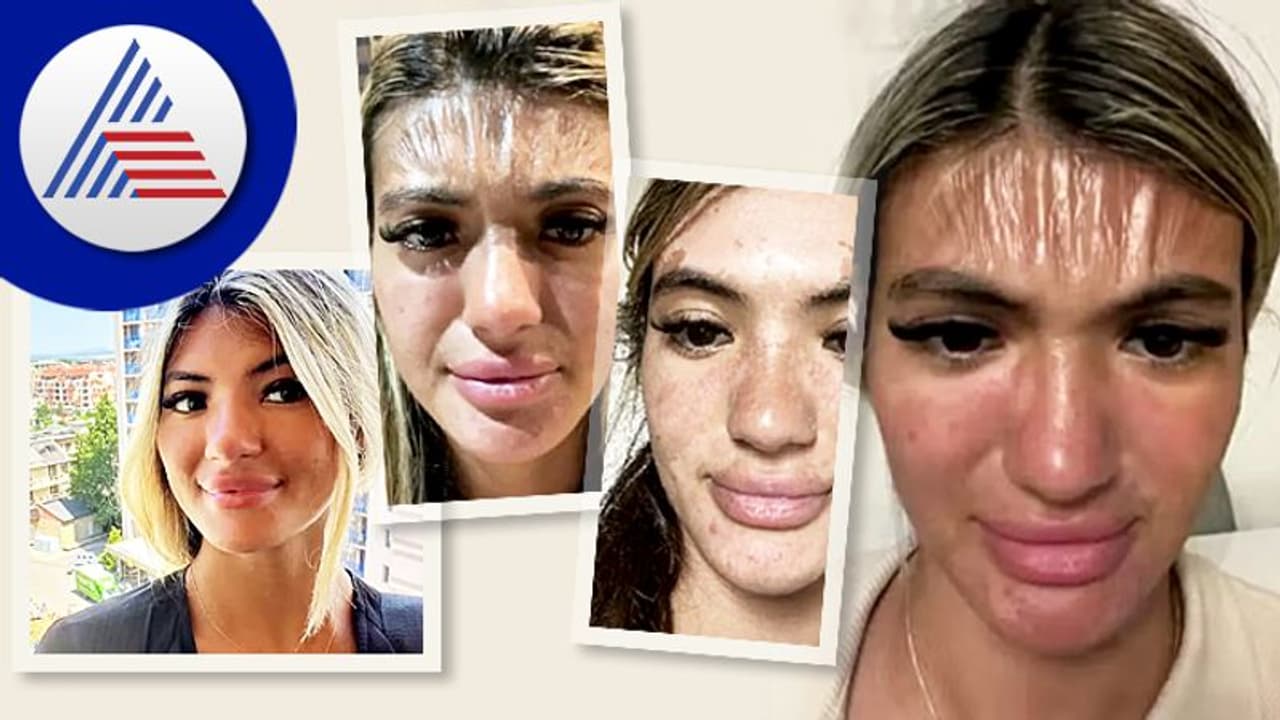 30 ನಿಮಿಷ ಬಿಸಿಲಿನಲ್ಲಿ ಮಲಗಿದ್ದ ಯುವತಿ, ಎದ್ದಾಗ ಮುಖ ನೋಡಿ ಗಾಬರಿಯೋ ಗಾಬರಿ ! 30 ನಿಮಿಷ ಬಿಸಿಲಿನಲ್ಲಿ ಮಲಗಿದ್ದ ಯುವತಿ, ಎದ್ದಾಗ ಮುಖ ನೋಡಿ ಗಾಬರಿಯೋ ಗಾಬರಿ !