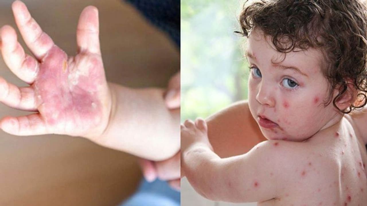 सावधान! छोटे बच्चों को Tomato Flu का अधिक खतरा, केंद्र ने जारी की गाइडलाइन,जानें लक्षण और इलाज