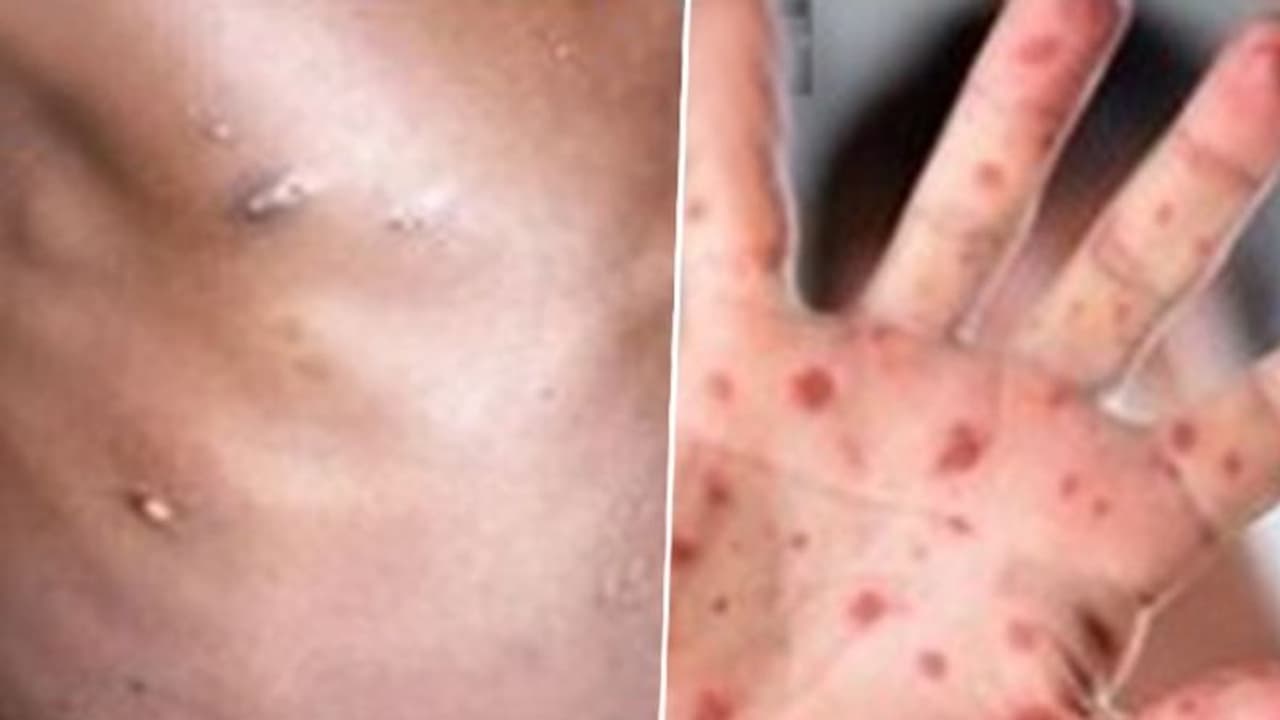 How is Tomato Flu different from Monkeypox? Know symptoms, treatment, and precautions here