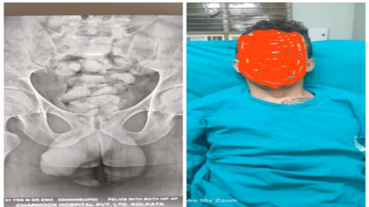 নিজের পাকস্থলীর মাধ্যমে মাদক পাচার, ব্রাজিলের যুবকের শরীর থেকে মিলল ৪৪টি মাদক ক্যাপসুল নিজের পাকস্থলীর মাধ্যমে মাদক পাচার, ব্রাজিলের যুবকের শরীর থেকে মিলল ৪৪টি মাদক ক্যাপসুল