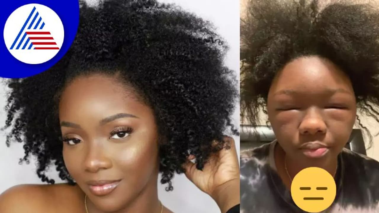 ಹೇರ್‌ ಡೈ ಅಲರ್ಜಿ, ಎಮೋಜಿಯಂತಾಯ್ತ ಮಹಿಳೆಯ ಮುಖ !