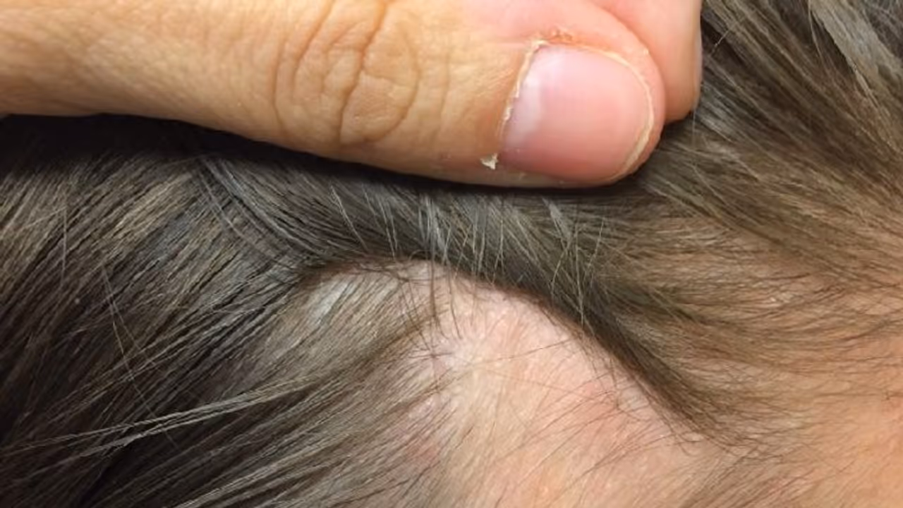 Syphilis Symptoms : ലൈംഗികരോഗത്തിന്‍റെ ലക്ഷണങ്ങള്‍ മുടിയിലും വായിലും കാണാം