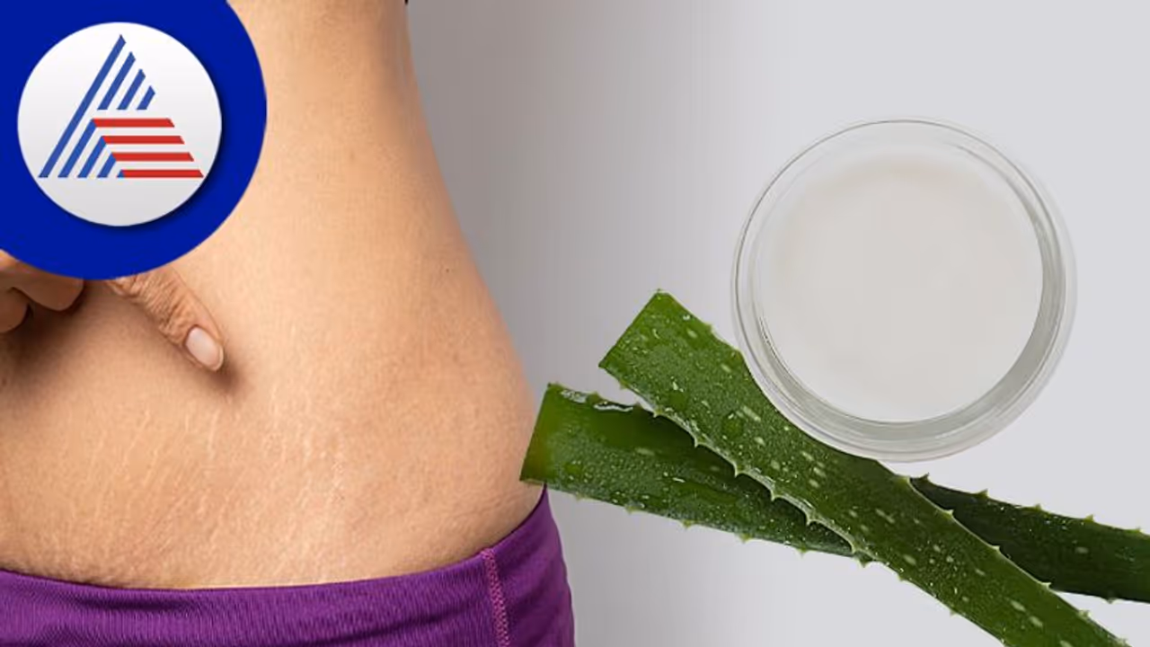 ಗರ್ಭಾವಸ್ಥೆಯ Stretch Mark ನಿರ್ಮೂಲನೆಗೆ ಮನೆಮದ್ದು! ಗರ್ಭಾವಸ್ಥೆಯ Stretch Mark ನಿರ್ಮೂಲನೆಗೆ ಮನೆಮದ್ದು!