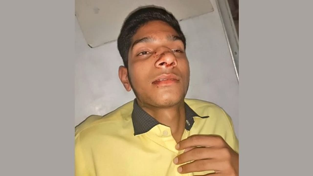 पार्टी के लिए होस्टल संचालक मांग रहा था रुपए, नहीं देने पर दी खौफनाक सजा, टूटी नाक, हाथ के साथ पहुंचा हॉस्पिटल