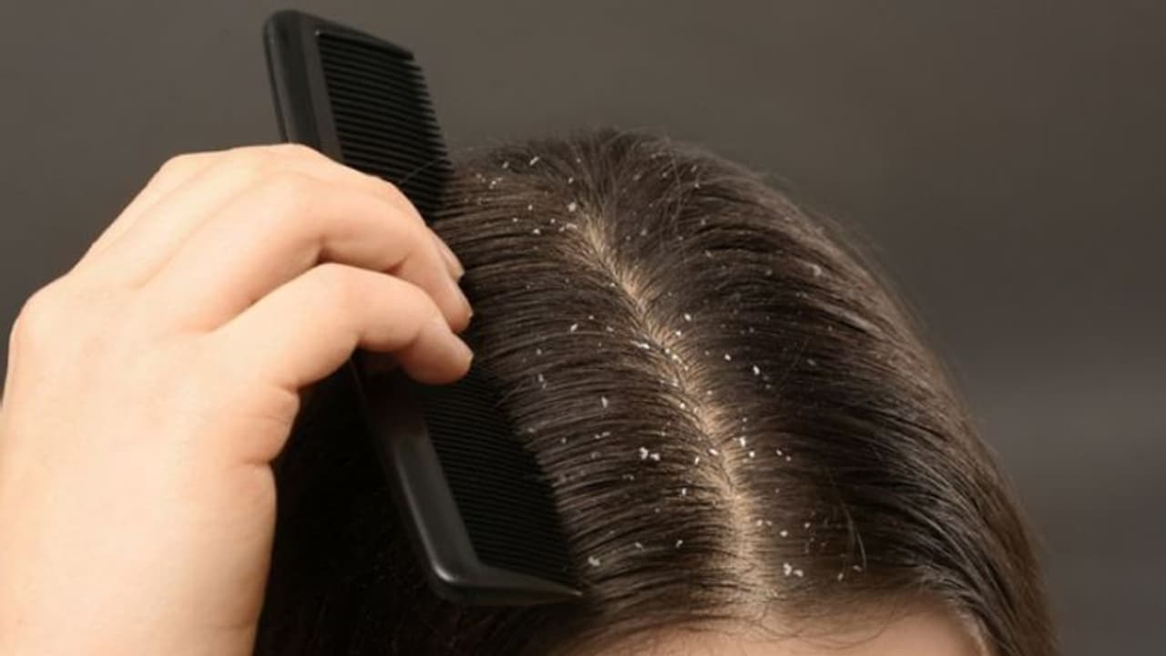 Dandruff Home Remedies : താരൻ അകറ്റാൻ ഇതാ മൂന്ന് പൊടിക്കെെകൾ Dandruff Home Remedies : താരൻ അകറ്റാൻ ഇതാ മൂന്ന് പൊടിക്കെെകൾ