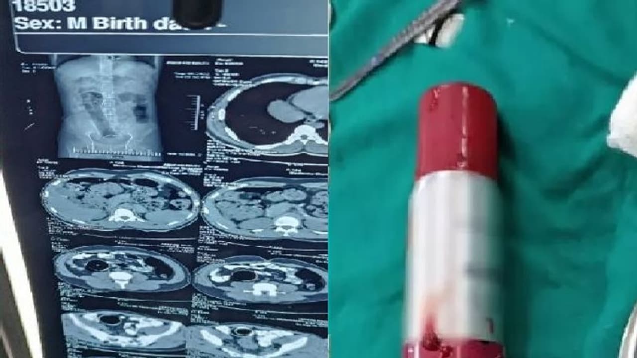 பின்புறத்தில் செண்ட் பாட்டிலை சொருகிய நபர்… இயற்கை உபாதை கழிக்க முடியாமல் தவிப்பு… அடுத்து நடந்தது என்ன? பின்புறத்தில் செண்ட் பாட்டிலை சொருகிய நபர்… இயற்கை உபாதை கழிக்க முடியாமல் தவிப்பு… அடுத்து நடந்தது என்ன?