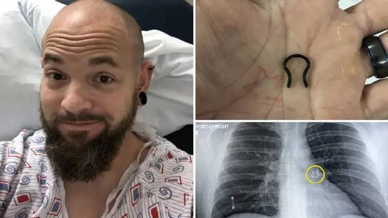 കാണാതായ നോസ്റിംഗ് ശ്വാസകോശത്തിൽ, അന്തംവിട്ട് യുവാവും ഡോക്ടർമാരും കാണാതായ നോസ്റിംഗ് ശ്വാസകോശത്തിൽ, അന്തംവിട്ട് യുവാവും ഡോക്ടർമാരും