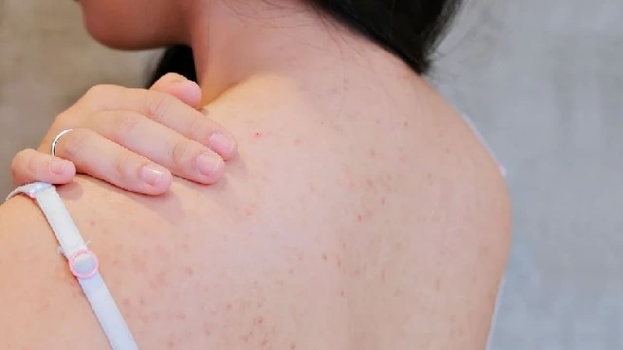 മുതുകിൽ വരുന്ന കുരു; ഇതൊഴിവാക്കാൻ ചെയ്യേണ്ടത് മുതുകിൽ വരുന്ന കുരു; ഇതൊഴിവാക്കാൻ ചെയ്യേണ്ടത്