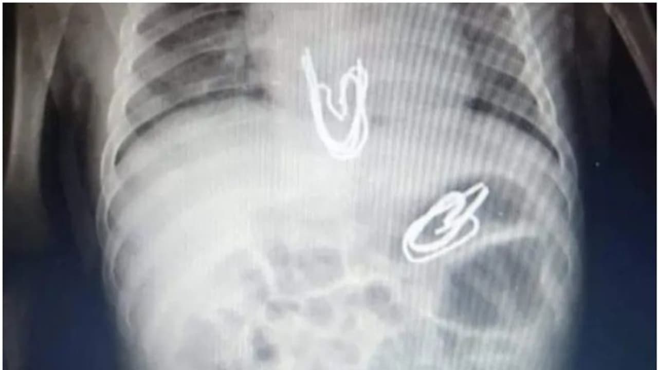 മൂന്നു മാസം പ്രായമുള്ള കുഞ്ഞിന്റെ വയറ്റില് കണ്ടെത്തിയത് കര്ട്ടന് ഹുക്കുകള്; സഹോദരി ഇട്ടതെന്ന് അമ്മ മൂന്നു മാസം പ്രായമുള്ള കുഞ്ഞിന്റെ വയറ്റില് കണ്ടെത്തിയത് കര്ട്ടന് ഹുക്കുകള്; സഹോദരി ഇട്ടതെന്ന് അമ്മ