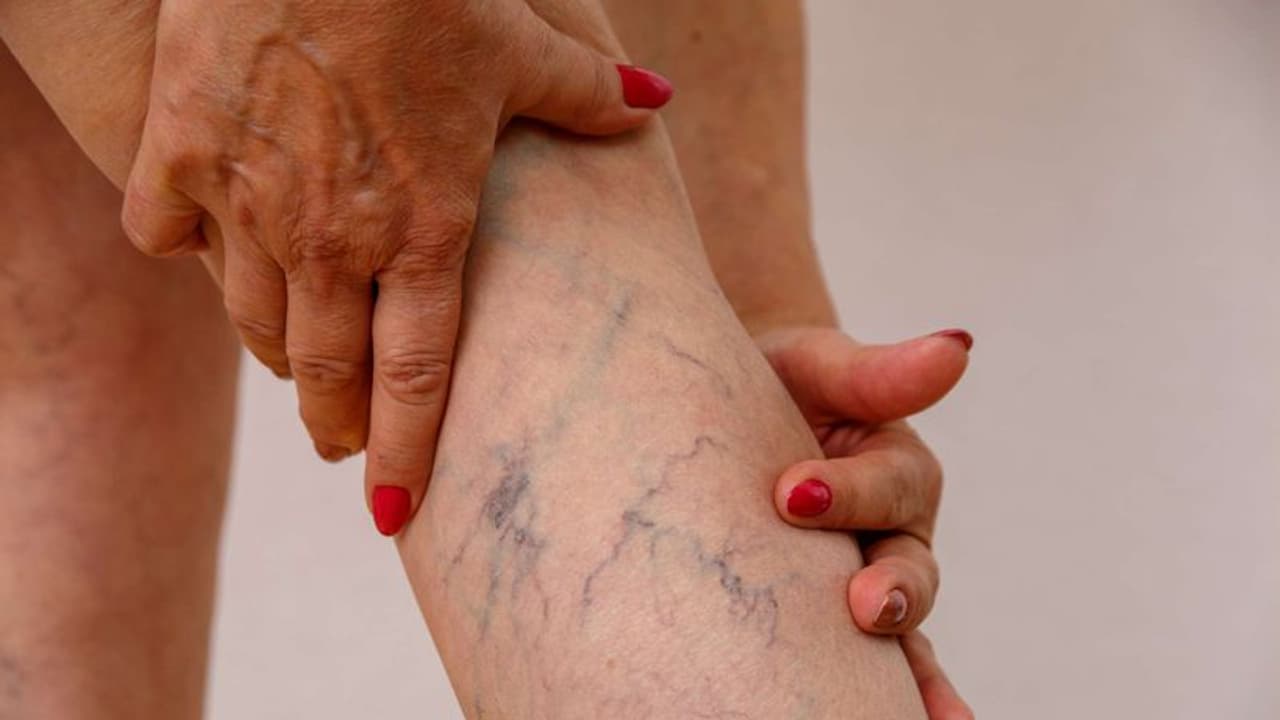 ആർത്തവവിരാമ സമയത്ത് സ്ത്രീകൾക്ക് വെരിക്കോസ് വെയിൻ ഉണ്ടാകാനുള്ള സാധ്യത കൂടുതലാണോ? ആർത്തവവിരാമ സമയത്ത് സ്ത്രീകൾക്ക് വെരിക്കോസ് വെയിൻ ഉണ്ടാകാനുള്ള സാധ്യത കൂടുതലാണോ?