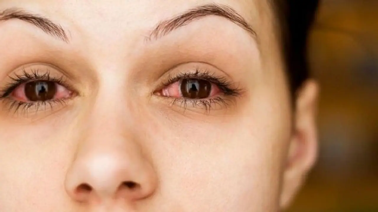 കണ്ണില്‍ ചുവപ്പുനിറം പടരുന്നതിന് കാരണമാകുന്ന അഞ്ച് കാര്യങ്ങള്‍...