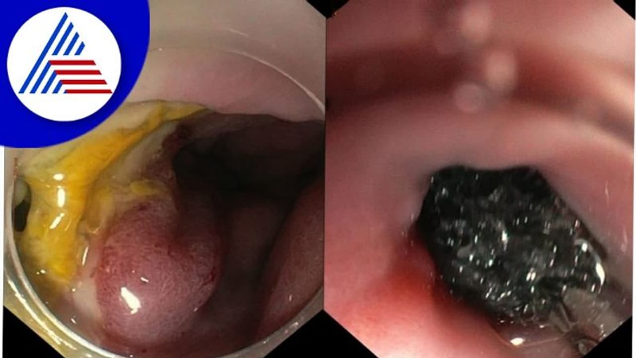 ಉಡುಪಿ: ಅಪರೂಪದ ಎಂಡೋಸ್ಕೋಪಿ ಸ್ಪಾಂಜ್ ಚಿಕಿತ್ಸೆ ಇದು ಕರ್ನಾಟಕದಲ್ಲೇ ಮೊದಲು!