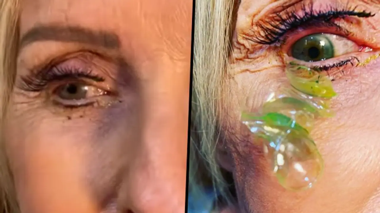Doctor removes 23 contact lenses from patient's eye; viral video stunned netizens Doctor removes 23 contact lenses from patient's eye; viral video stunned netizens