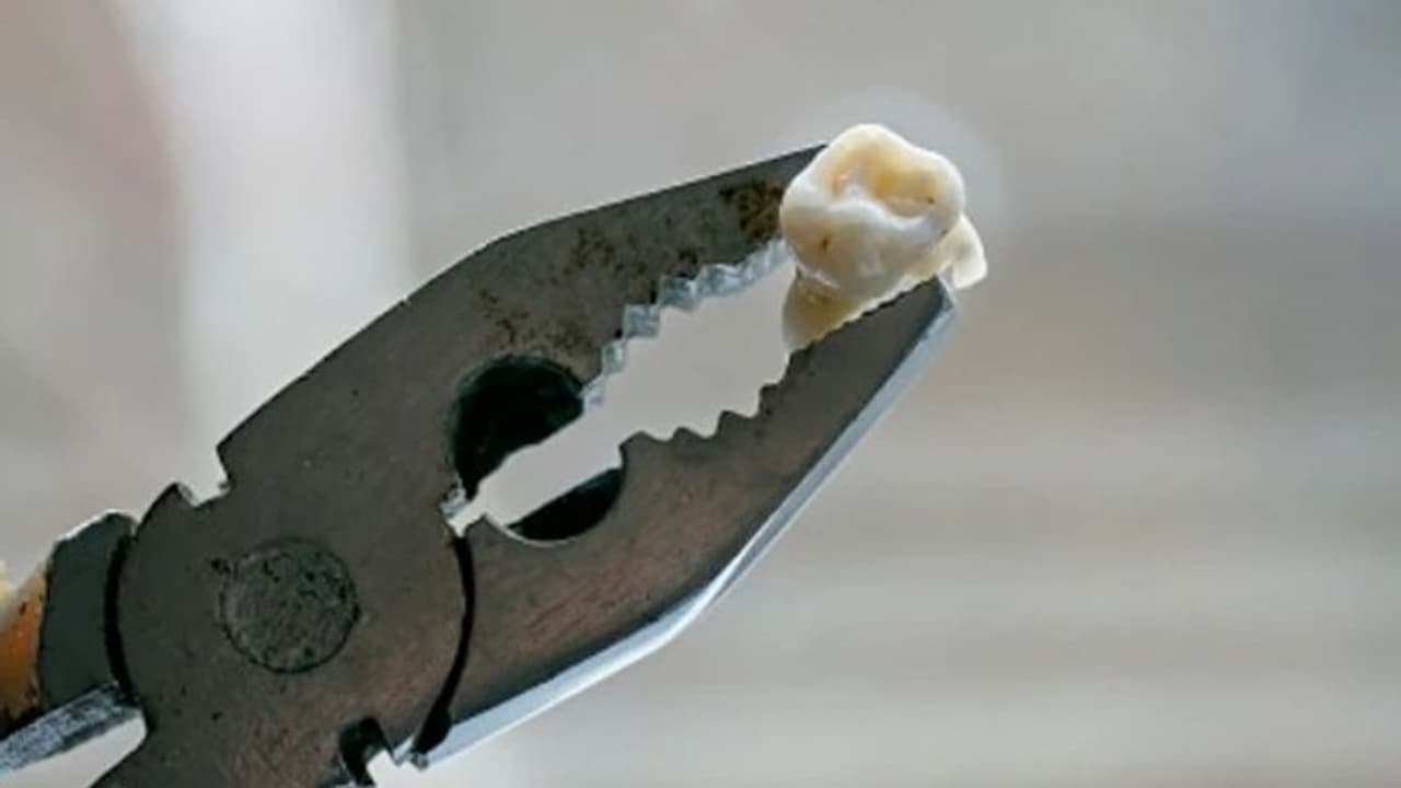 ഡോക്ടര്മാരുടെ അപ്പോയിന്മെന്റ് കിട്ടാറില്ല; 15 വര്ഷമായി സ്വയം പല്ല് പറിക്കുന്നൊരാള് ഡോക്ടര്മാരുടെ അപ്പോയിന്മെന്റ് കിട്ടാറില്ല; 15 വര്ഷമായി സ്വയം പല്ല് പറിക്കുന്നൊരാള്