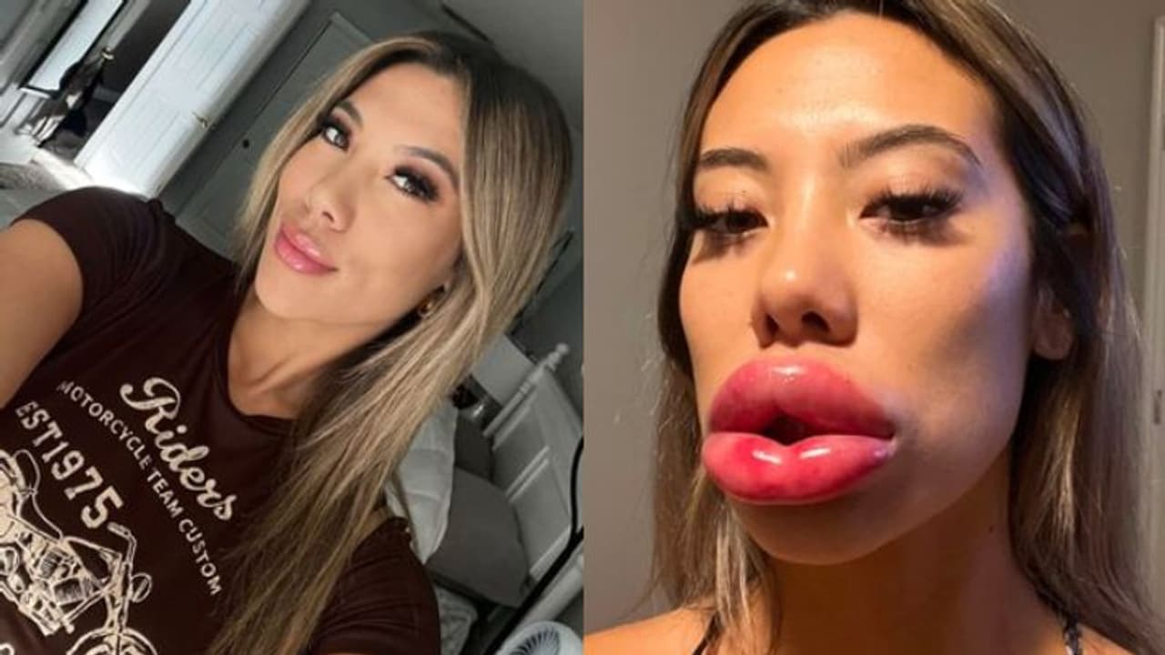 ലിപ് ഫില്ലര്‍ ചെയ്തശേഷം ചുണ്ട് മൂന്നിരട്ടിയായി വീര്‍ത്തു; മുറിഞ്ഞുപോകുമോയെന്ന് ഭയന്നെന്ന് യുവതി