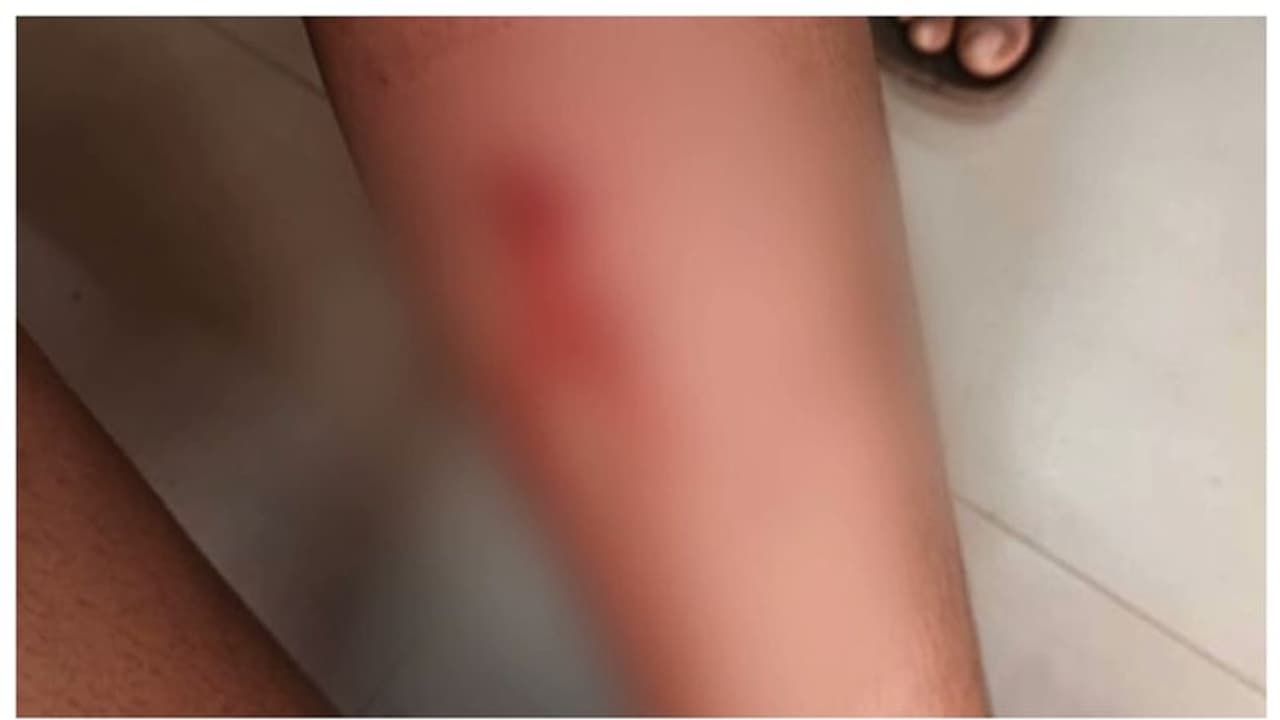 കണ്ണൂരില്‍ സ്കൂള്‍ വരാന്തയില്‍വച്ച് വിദ്യാര്‍ത്ഥിക്ക് തെരുവുനായയുടെ കടിയേറ്റു