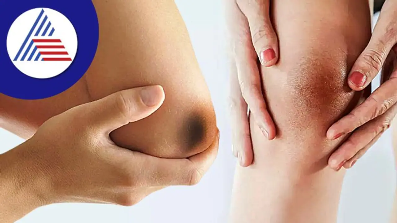 ಮೊಣಕೈ, ಮೊಣಕಾಲು ಕಪ್ಪಾಗಿದ್ದರೆ ಹೀಗ್ ಮಾಡಿ, ಸರಿ ಹೋಗುತ್ತೆ!