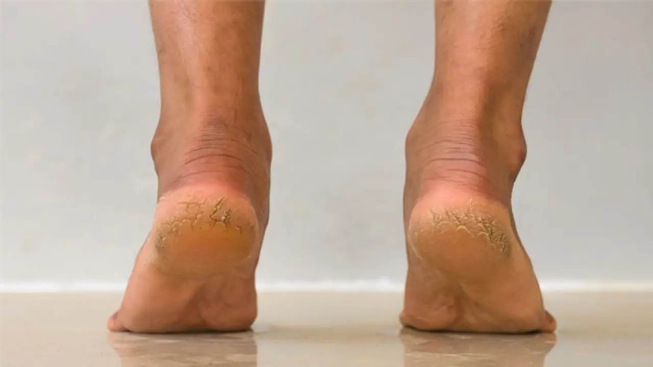 सर्दी में सबसे ज्यादा परेशान करती हैं फटी एड़िया,बस रोज रात में लगाए इन 5 चीजों में से एक, फिर देखें कमाल सर्दी में सबसे ज्यादा परेशान करती हैं फटी एड़िया,बस रोज रात में लगाए इन 5 चीजों में से एक, फिर देखें कमाल