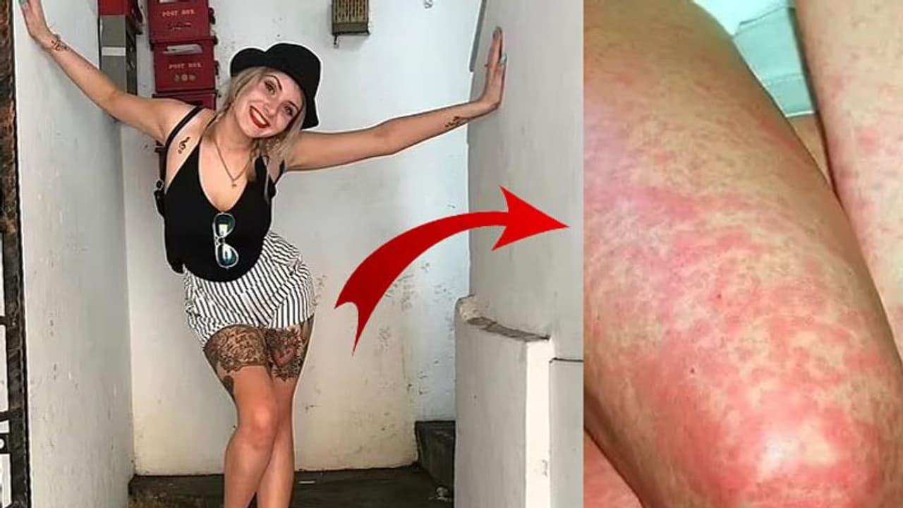 लड़की जिसे समझ रही थी शेविंग रैश, वो निकली ये भयानक बीमारी जिसने याददाश्त तक छीन ली लड़की जिसे समझ रही थी शेविंग रैश, वो निकली ये भयानक बीमारी जिसने याददाश्त तक छीन ली