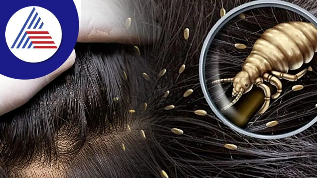 ಮಕ್ಕಳ ತಲೆಯಲ್ಲಿ ಹೇನಿನ ಕಾಟವೇ, ತೆಲೆ ಕೆಡಿಸಿಕೊಳ್ಳಬೇಡಿ, ಈ ಮನೆ ಮದ್ದು ಟ್ರೈ ಮಾಡಿ