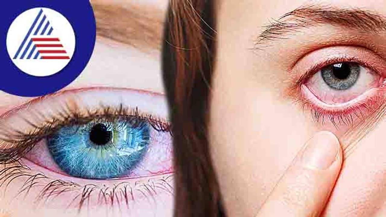 Pink Eye ಗುಣಪಡಿಸಿಕೊಳ್ಳಲು ಇಲ್ಲಿವೆ ಸಿಂಪಲ್ ಮನೆಮದ್ದು! Pink Eye ಗುಣಪಡಿಸಿಕೊಳ್ಳಲು ಇಲ್ಲಿವೆ ಸಿಂಪಲ್ ಮನೆಮದ್ದು!