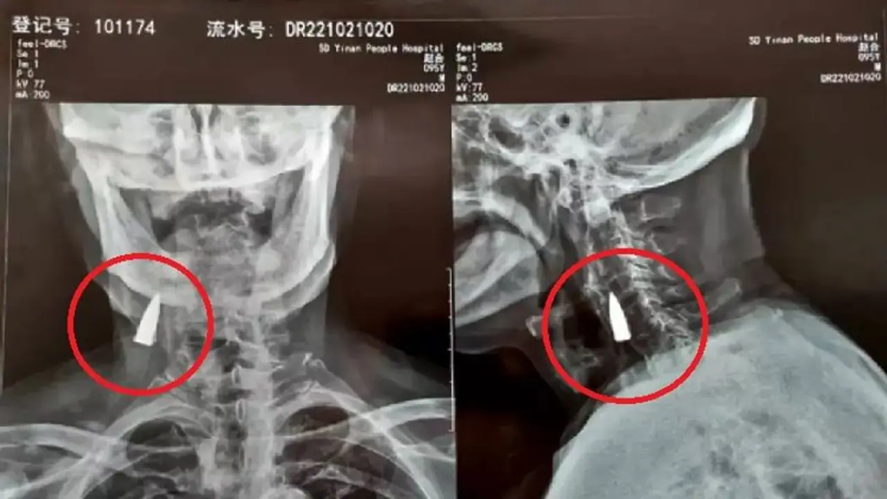 80 ஆண்டுகளாக கழுத்தில் இருந்த துப்பாக்கி தோட்டா… எக்ஸ்ரே எடுத்த போது தெரியவந்ததால் அதிர்ச்சி!! 80 ஆண்டுகளாக கழுத்தில் இருந்த துப்பாக்கி தோட்டா… எக்ஸ்ரே எடுத்த போது தெரியவந்ததால் அதிர்ச்சி!!