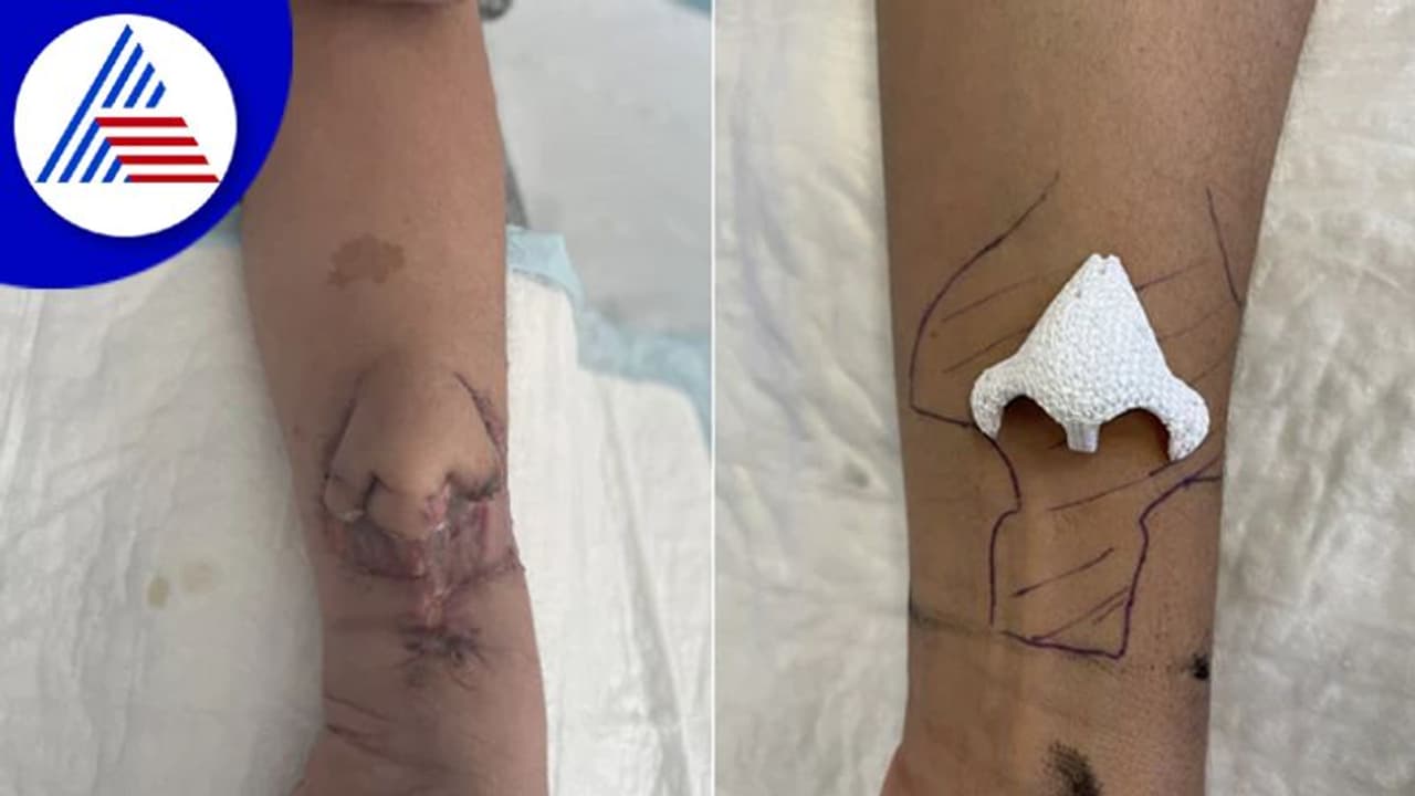 Nose Transplant: ತೋಳಿನಲ್ಲಿ ಮೂಗು ಬೆಳೆಸಿ ಮಹಿಳೆಯ ಮುಖಕ್ಕೆ ಯಶಸ್ವಿ ಕಸಿ