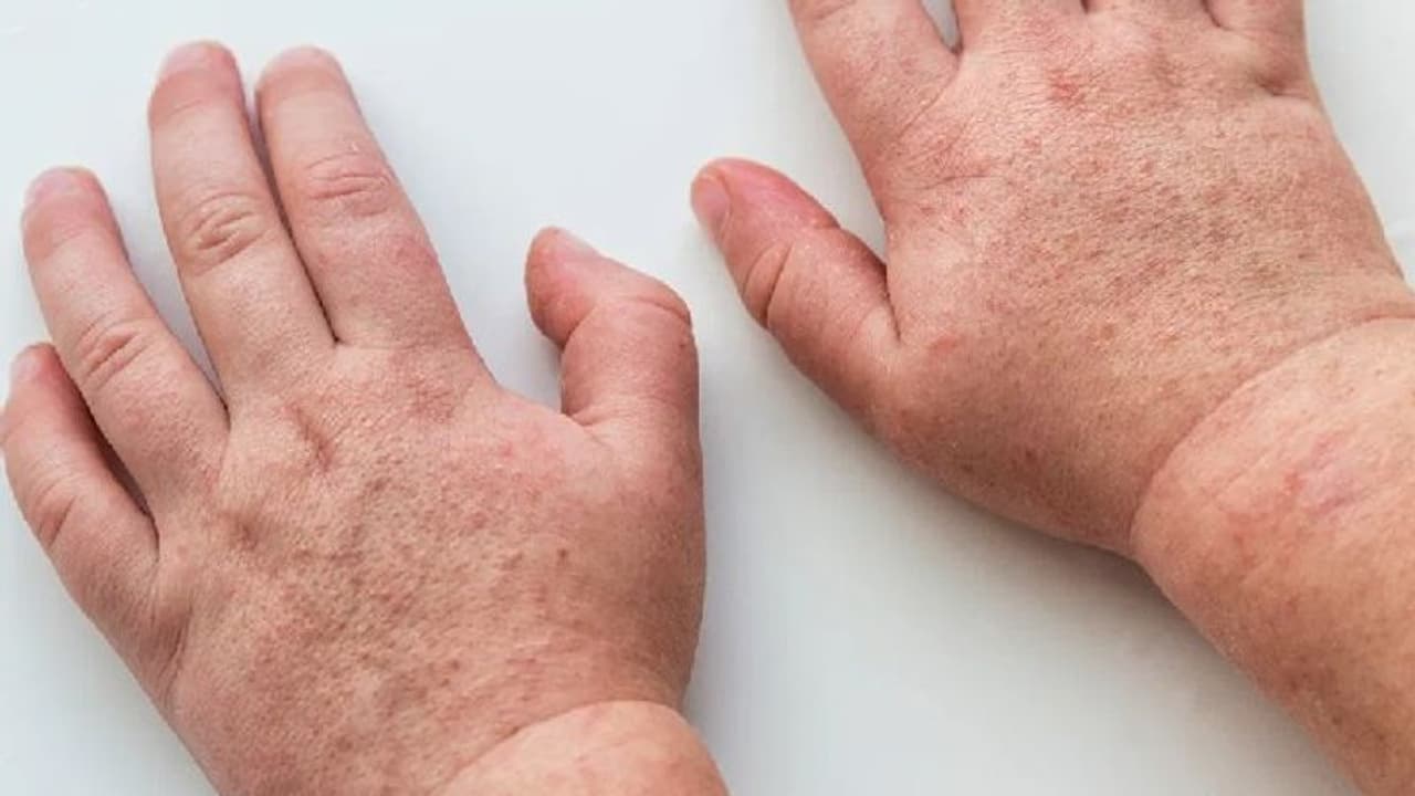 കുട്ടികളെ ബാധിക്കുന്ന 'സ്കാര്‍ലെറ്റ് ഫീവര്‍'; കേസുകള്‍ കൂടുന്നതായി യുകെയില്‍ നിന്ന് ഡോക്ടര്‍മാര്‍