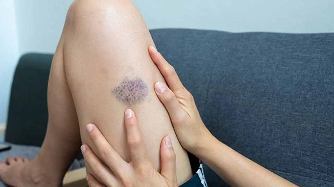 Skin Lesions: சர்க்கரை நோயாளிகளே: தோல் புண்களை சரி செய்யும் சில எளிய முறைகள்!