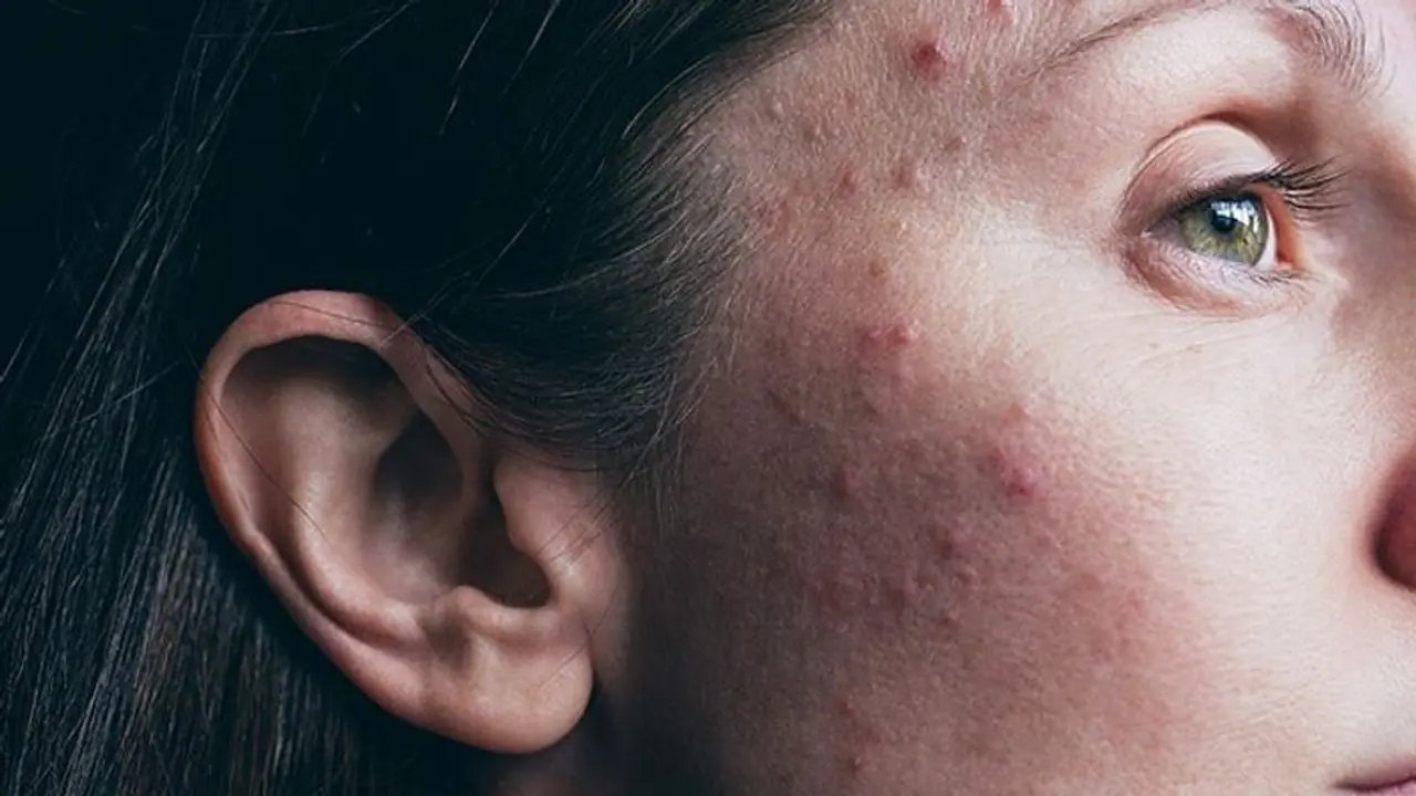 Google Lens will help you in detecting rashes, skin conditions and more; Here's how it works