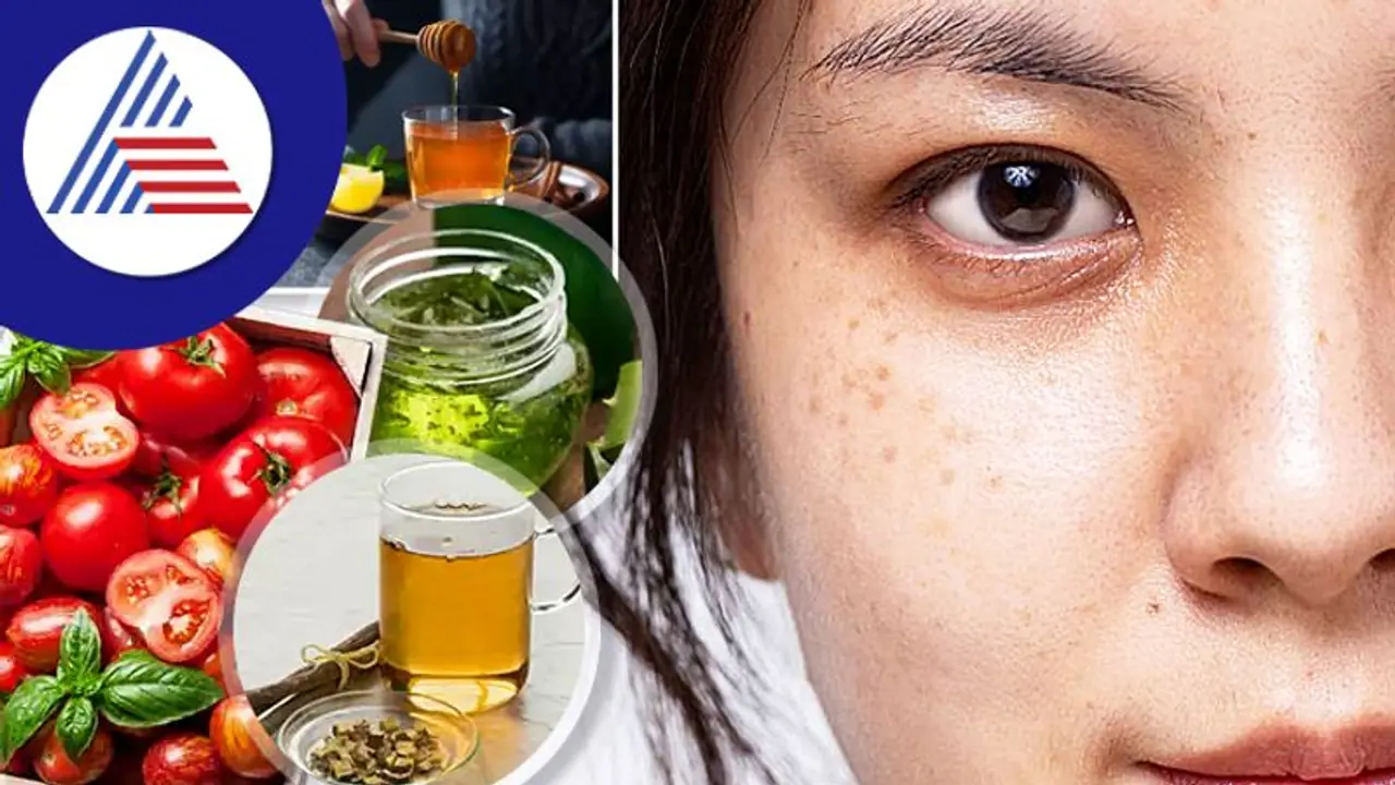 கரும்புள்ளிகளை எளிதாக நீக்கும் 4 சமையலறை பொருட்கள்..!! கரும்புள்ளிகளை எளிதாக நீக்கும் 4 சமையலறை பொருட்கள்..!!